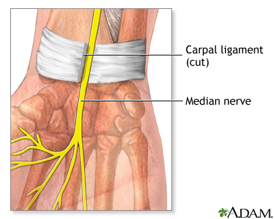 carpal ligament