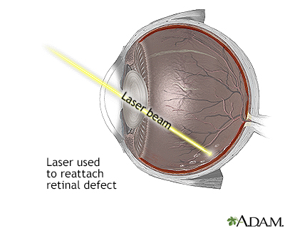 hole in retina repair