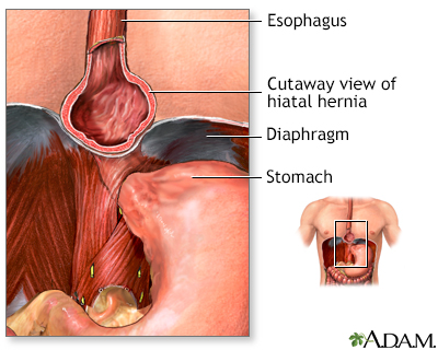 diazepam to treat spastic esophagus pain relief