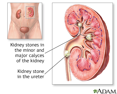 Kidney Stones Penn State Hershey Medical Center