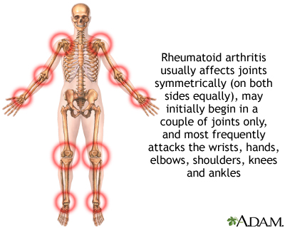 Does methotrexate cause mouth sores joint pain