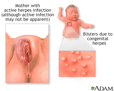 herpes symptoms lips. an active herpes infection