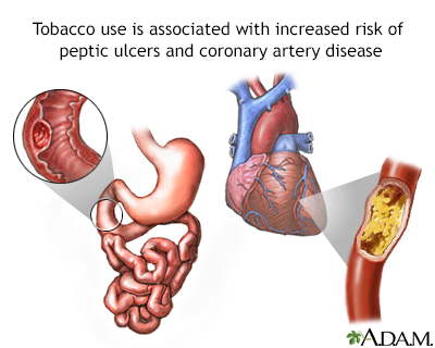 Tramadol and peptic ulcer disease