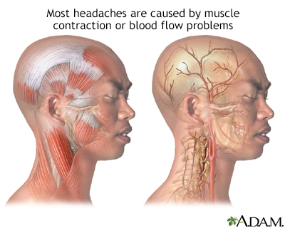 Elavil for tension headaches in pregnancy