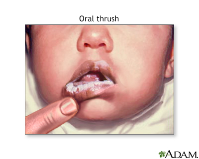 oral thrush in children