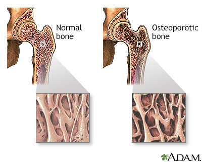 cracked pubic bone symptoms