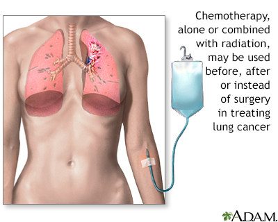 before and after smoking lungs. Non-small cell lung cancer