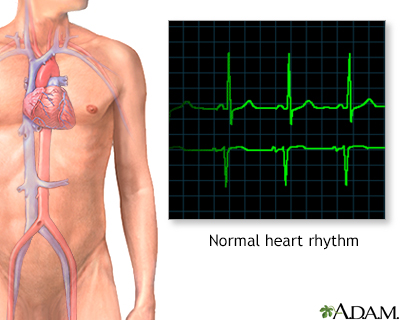 heart attack ecg. ECG