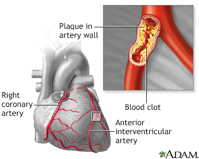 heart attack symptoms pictures. heart attack,