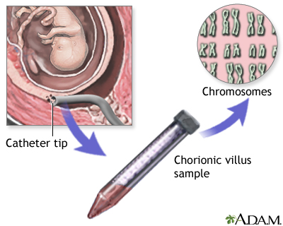 chorionic villus sampling chorionic villus sampling