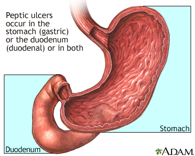 Stomach, Ulcers, Gastric Bypass Forum.