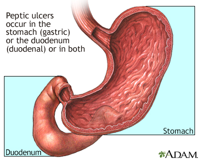 does tramadol cause ulcers