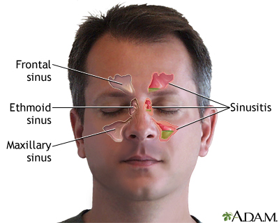 blocked sinus