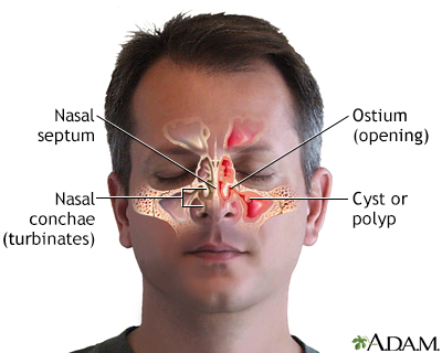 sinus cysts and polyps