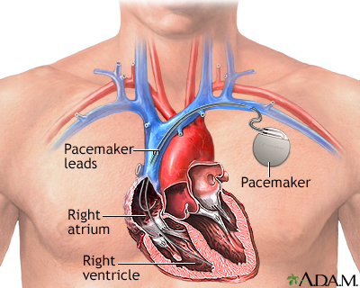 Heart Pacemakers And Slot Machines