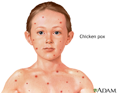 Chickenpox And Shingles What You Might Not Know Children S Physicians Medical Group