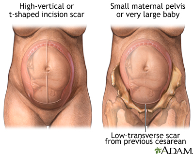 Epidural steroid injections during pregnancy