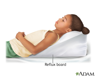 reflux board is a device prescribed for use in children who have GER 