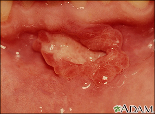 Medical Pictures Info – Janeway Lesion