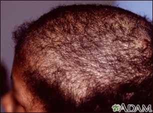 Mens Center Penn State Hershey Medical Center Trichotillomania