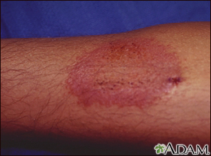 La psoriasis ha aparecido por todo el cuerpo