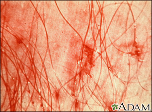 Pubic Lice Penn State Hershey Medical Center
