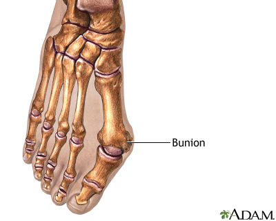 Shoes Bunions Women on Bunion Removal Series Penn State Hershey