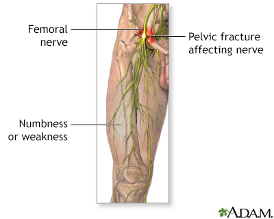 femoral artery pain