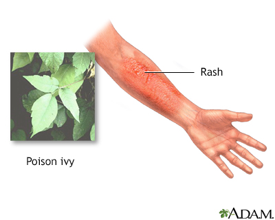 Care Guides Penn State Hershey Medical Center Poison Ivy Poison Oak Poison Sumac Penn State Hershey Medical Center,Low Sodium Soy Sauce Ingredients