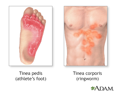 Think, that ringworm and vaginal delivery Confirm. was ringworm and vaginal delivery criticism advise