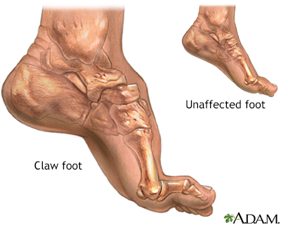 Acquired Flat Feet