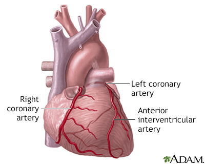 heart attack pain. A heart attack (myocardial