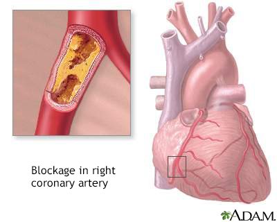 heart attack pain areas. Heart